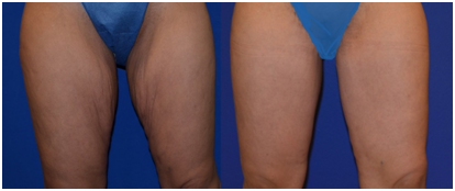Thigh Lift Treatment in Coimbatore