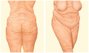 Tummy Tuck in Coimbatore