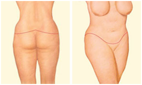 Tummy Tuck Surgery in Coimbatore