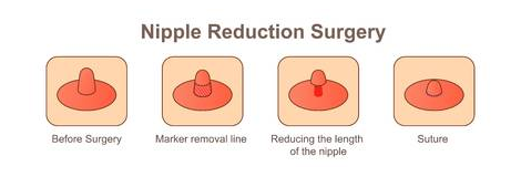 Breast Reduction Surgery in Coimbatore