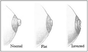 Nipple Correction in Coimbatore