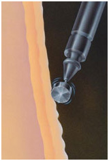 Chemical Peeling in Coimbatore