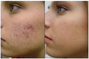Pimple Treatment in Coimbatore