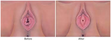 Hymenoplasty in Coimbatore