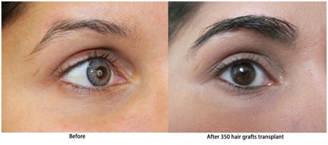 Eyebrow Transplant in Coimbatore