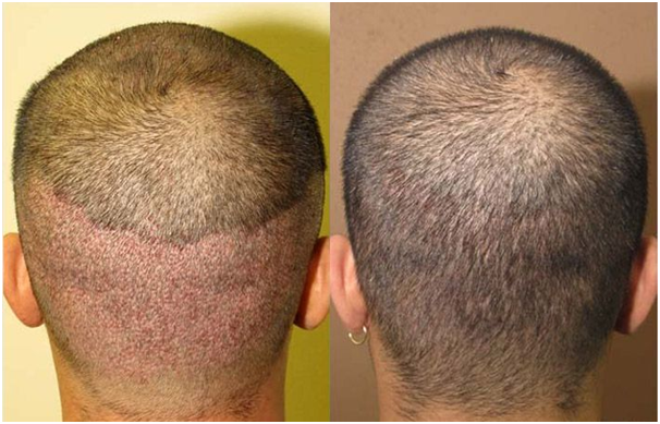 hair transplant in coimbatore