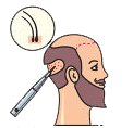 Hair Transplantation in Coimbatore