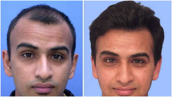 hair transplant in coimbatore