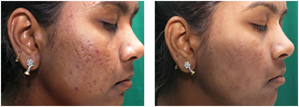 Scar Management in Coimbatore