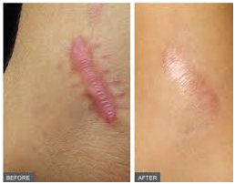 Scar Management in Coimbatore