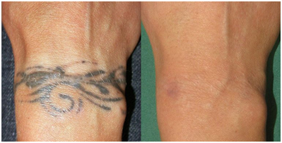 Tattoo Removal in Coimbatore